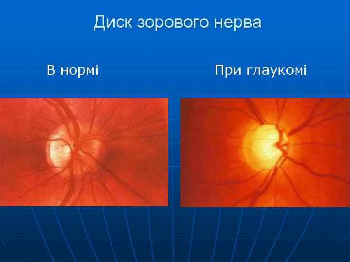  Диск зорового нерва В нормі  При глаукомі 