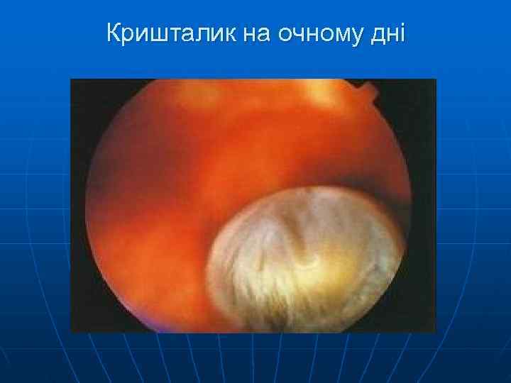 Кришталик на очному дні 