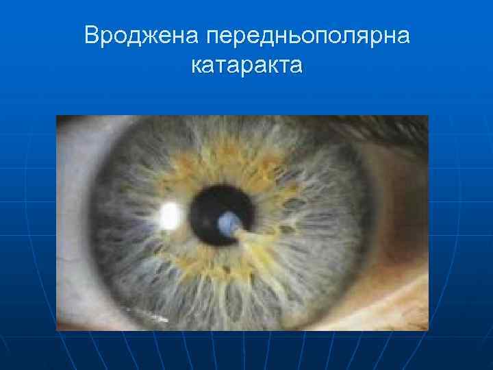 Вроджена передньополярна  катаракта 