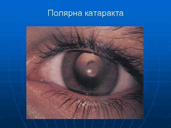 Полярна катаракта 