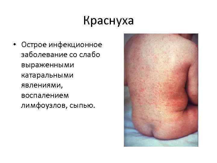    Краснуха • Острое инфекционное  заболевание со слабо  выраженными 