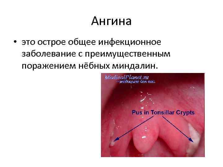     Ангина • это острое общее инфекционное  заболевание с преимущественным