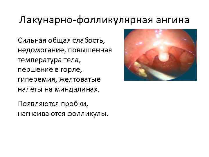 Лакунарно-фолликулярная ангина Сильная общая слабость, недомогание, повышенная температура тела, першение в горле, гиперемия, желтоватые