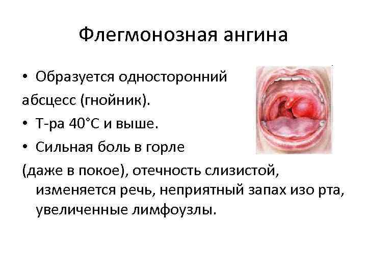   Флегмонозная ангина • Образуется односторонний абсцесс (гнойник).  • Т-ра 40°С и