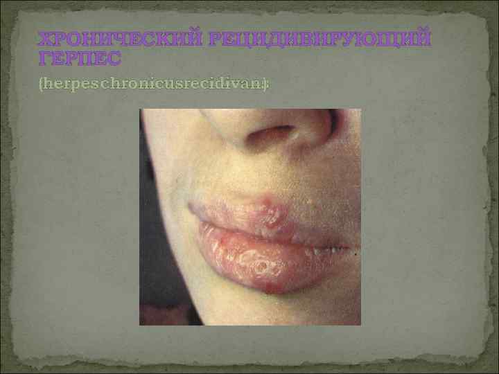 ХРОНИЧЕСКИЙ РЕЦИДИВИРУЮЩИЙ ГЕРПЕС (herpes chronicusrecidivans      ) 