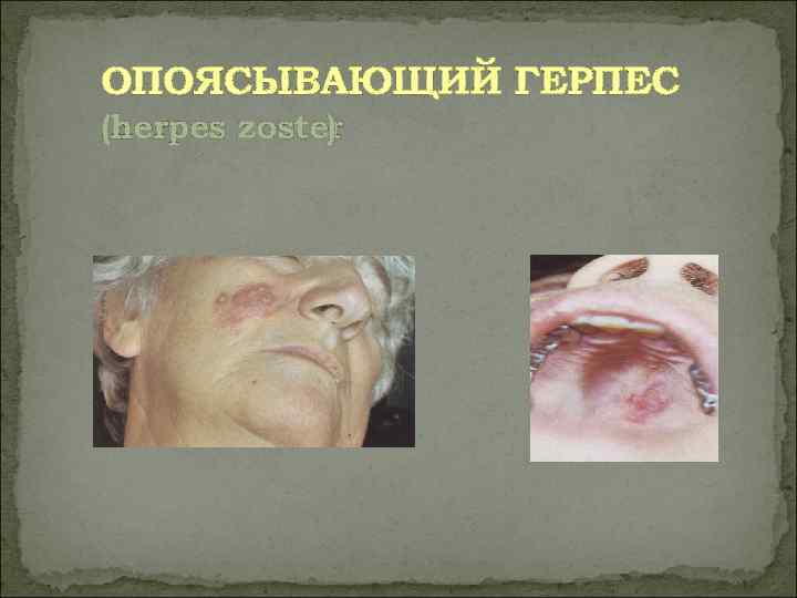 ОПОЯСЫВАЮЩИЙ ГЕРПЕС (herpes zoster   ) 