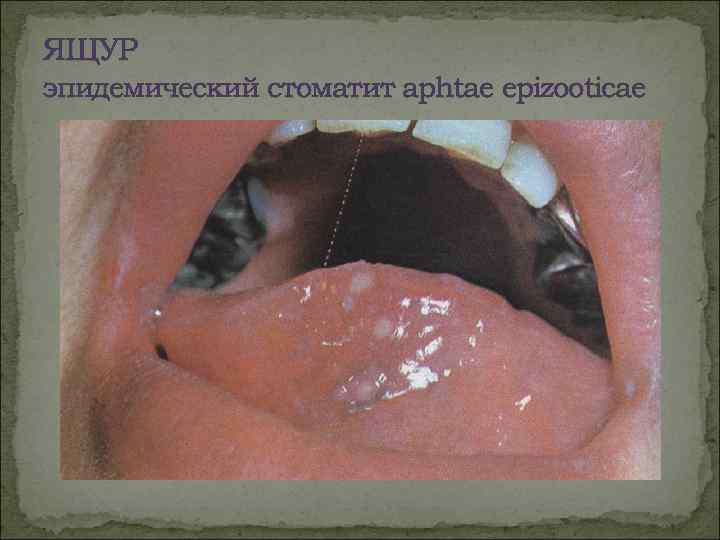 ЯЩУР эпидемический стоматит aphtae epizooticae 