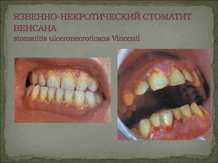 ЯЗВЕННО-НЕКРОТИЧЕСКИЙ СТОМАТИТ ВЕНСАНА stomatitis ulceronecroticans Vincenti 
