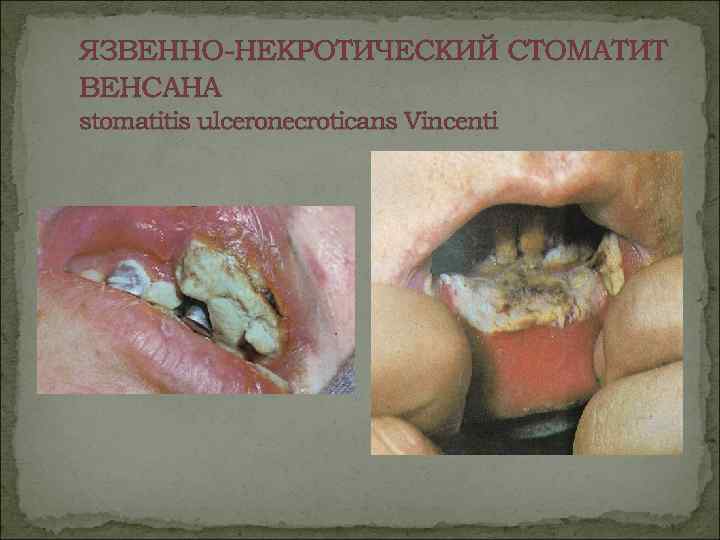 ЯЗВЕННО-НЕКРОТИЧЕСКИЙ СТОМАТИТ ВЕНСАНА stomatitis ulceronecroticans Vincenti 