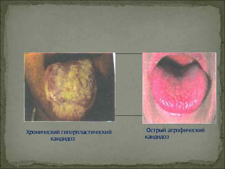 Хронический гиперпластический  Острый атрофический   кандидоз 