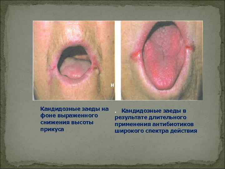     н  Кандидозные заеды на . Кандидозные заеды в фоне