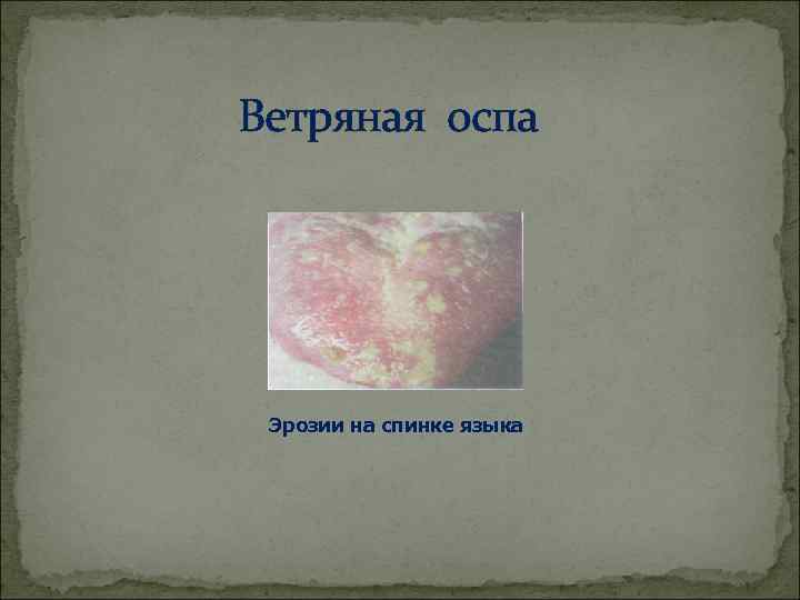 Ветряная оспа Эрозии на спинке языка 