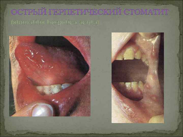 ОСТРЫЙ ГЕРПЕТИЧЕСКИЙ СТОМАТИТ (stomatitis herpetica асutа) 