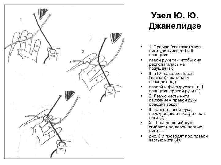   Узел Ю. Ю. Джанелидзе  •  1. Правую (светлую) часть нити