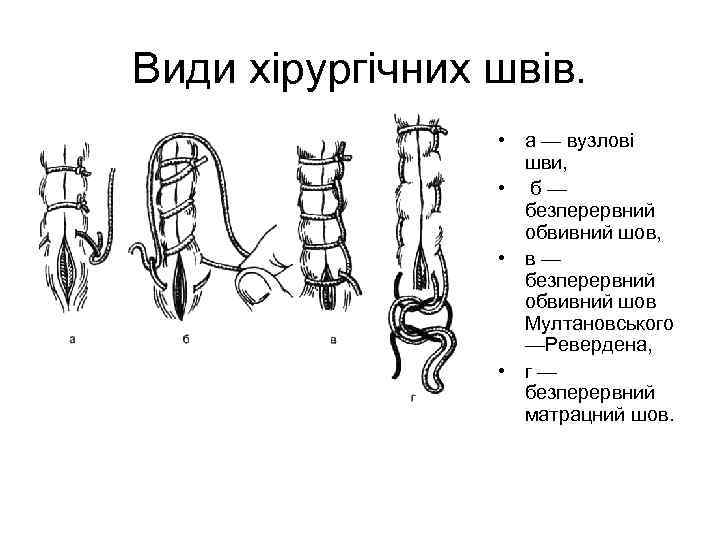 Шов мультановского схема