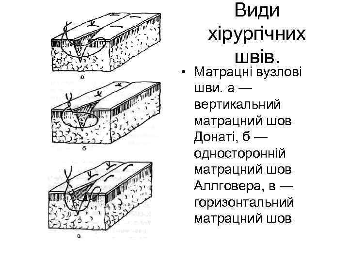   Види хірургічних   швів.  • Матрацні вузлові  шви. а