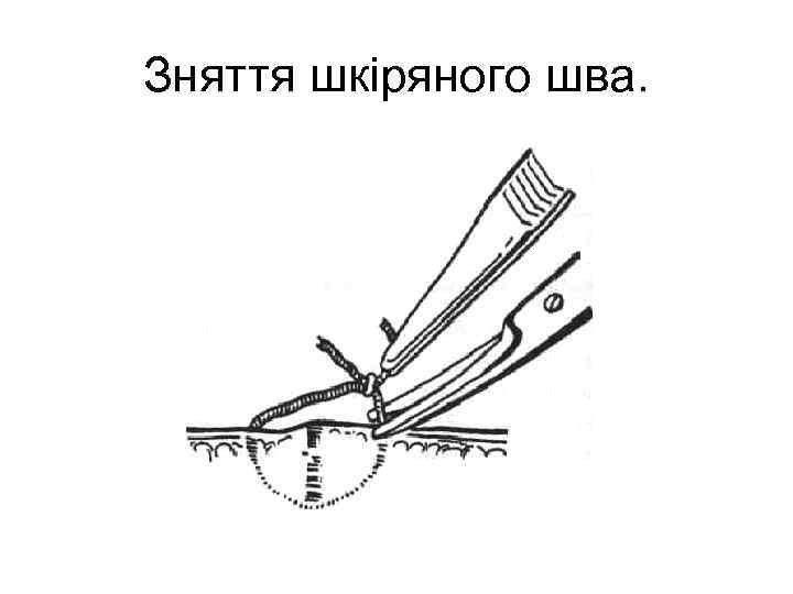 Зняття шкіряного шва.  