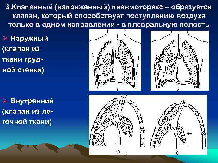 Карта смп пневмоторакс спонтанный