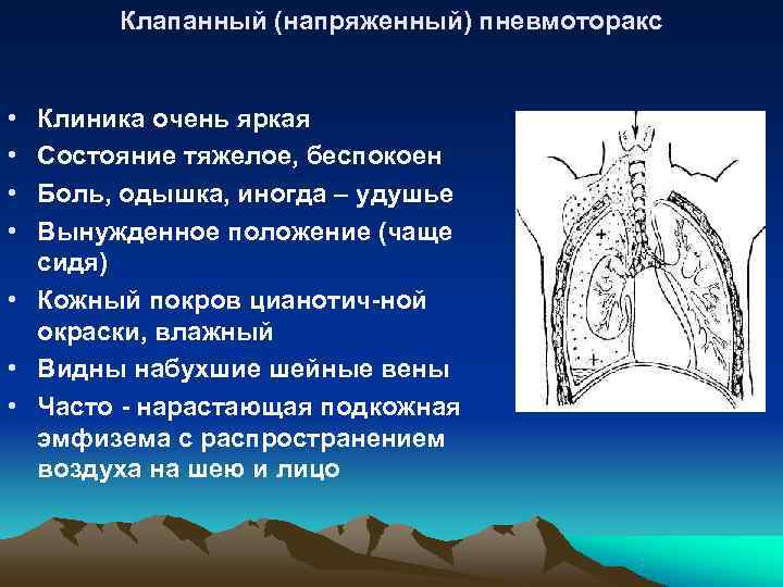 Клапанный (напряженный) пневмоторакс • Клиника очень яркая • Состояние тяжелое, беспокоен Клапанный (напряженный) пневмоторакс • Клиника очень яркая • Состояние тяжелое, беспокоен