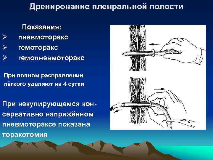 Дренирование плевральной полости