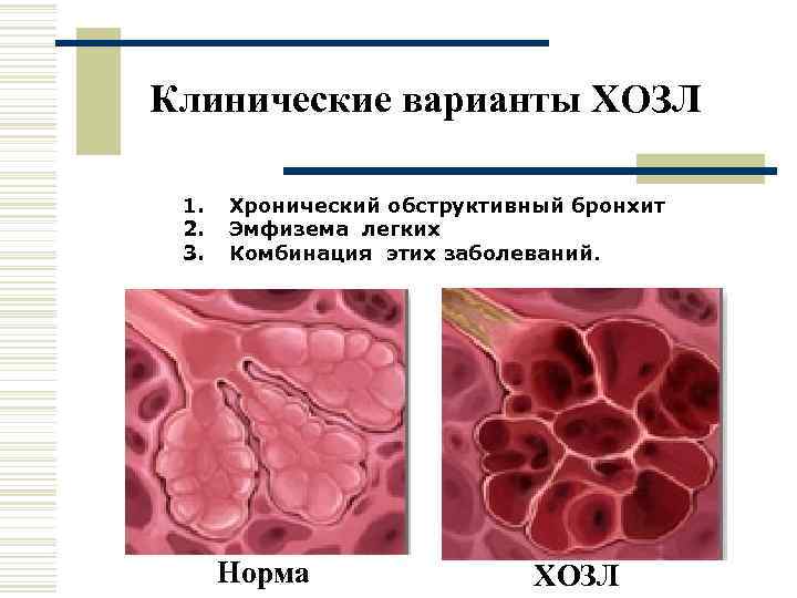 Клинические варианты ХОЗЛ  1.  Хронический обструктивный бронхит 2.  Эмфизема легких 3.