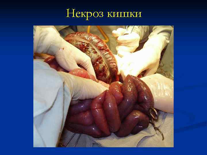 Некроз кишки 