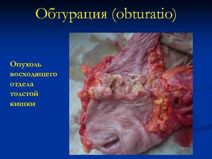  Обтурация (obturatio)  Опухоль восходящего отдела толстой кишки 