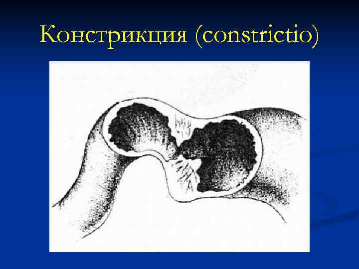 Констрикция (constrictio) 
