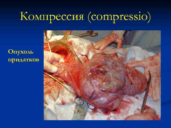   Компрессия (compressio) Опухоль придатков 