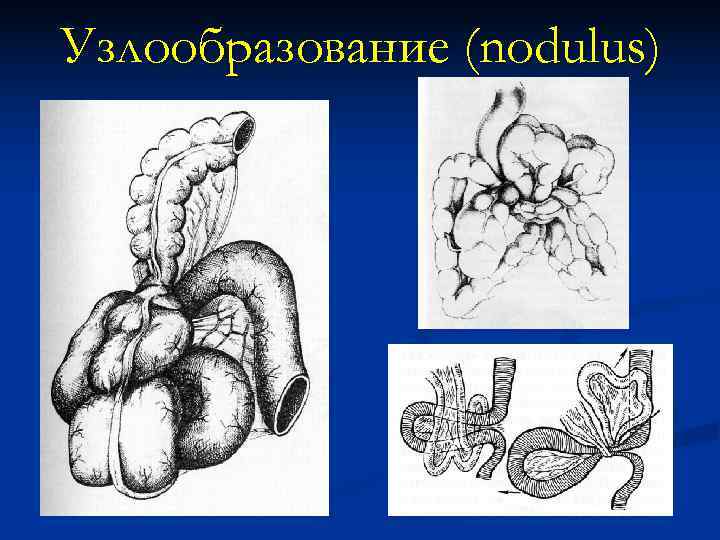 Узлообразование кишечника. Узлообразование кишечника симптомы. Кишечной непроходимости визуально. Заворот и узлообразование.