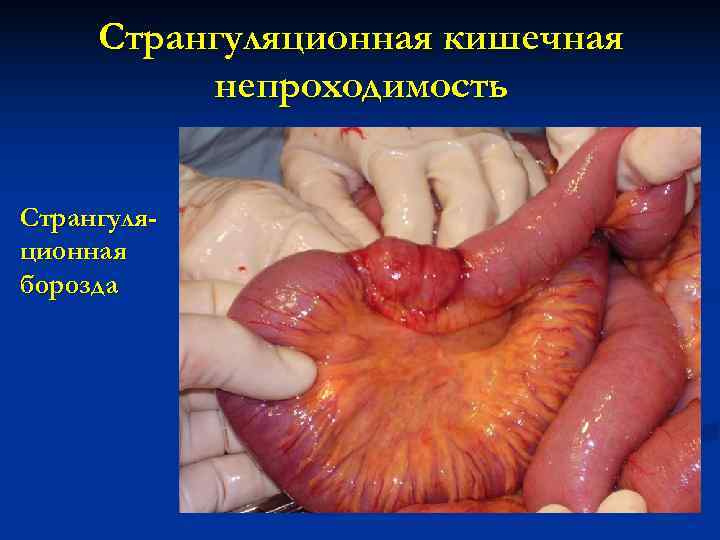  Странгуляционная кишечная  непроходимость  Странгуля- ционная борозда 