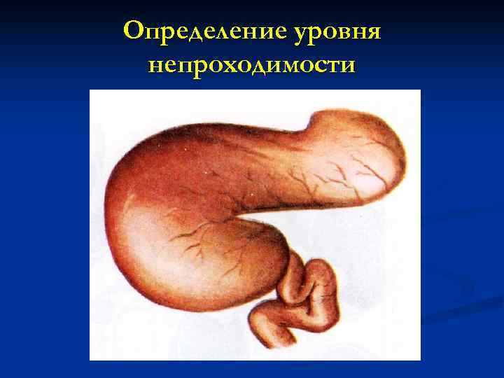 Определение уровня непроходимости 