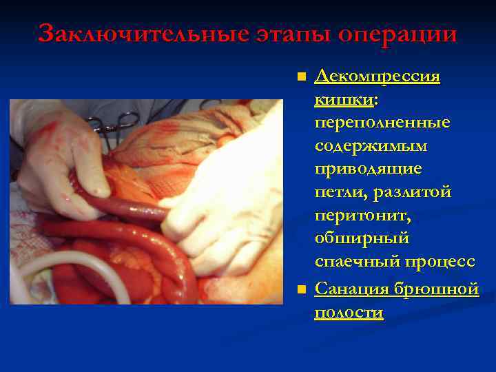 Заключительные этапы операции   n  Декомпрессия     кишки: 