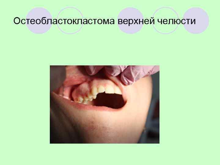 Остеобластокластома верхней челюсти (литическая форма) 