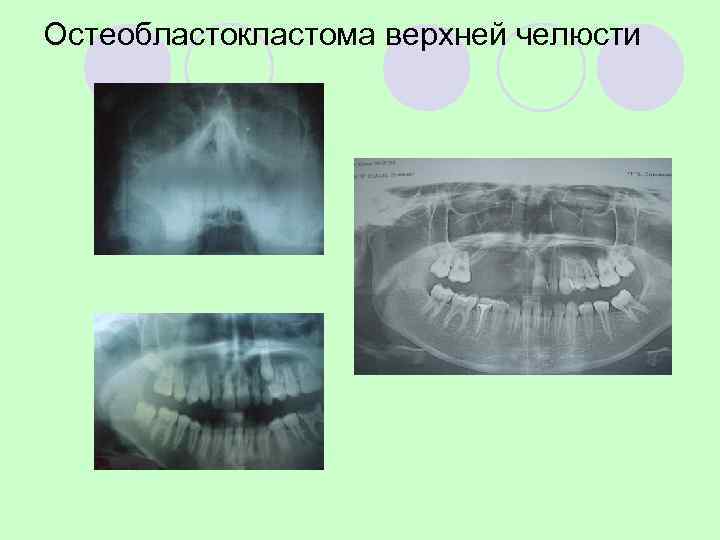 Остеобластокластома верхней челюсти (литическая форма) 