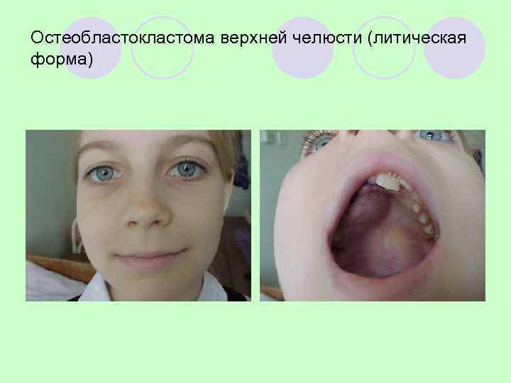 Остеобластокластома нижней челюсти (литическая форма) 