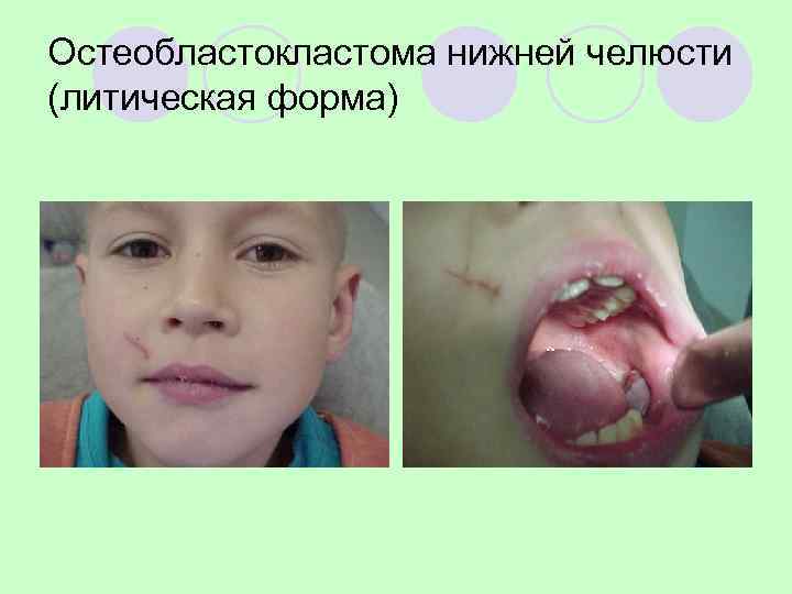 Остеобластокластома нижней челюсти (рецидив через 11 лет после операции) 