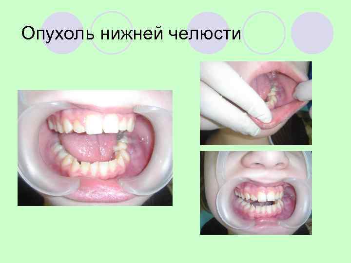 КЛАССИФИКАЦИЯ ОПУХОЛЕЙ КОСТЕЙ 4. Костномозговые опухоли (все злокачественные)  саркома Юинга ретикулосаркома кости лимфосаркома