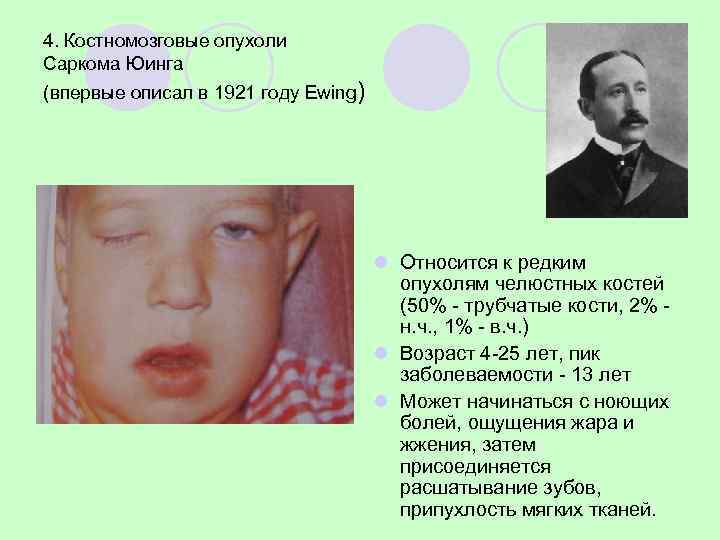 4. Костномозговые опухоли Саркома Юинга (впервые описал в 1921 году Ewing)   