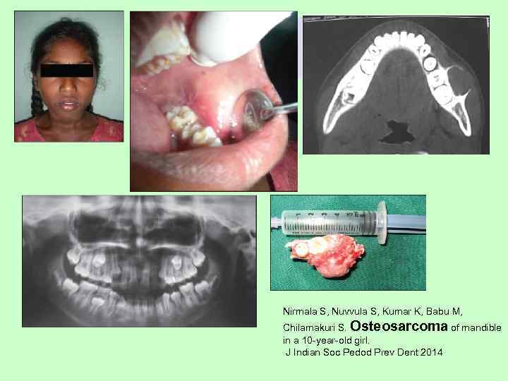 Naidu SR, Hegde RJ, Devrukhkar VN, Patel AR. Conservative management of unicystic ameloblastoma in