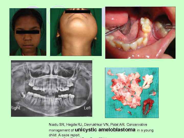 Yavagal C, Anegundi R, Shetty S. Unicystic plexiform ameloblastoma //J Indian Soc Pedod Prev