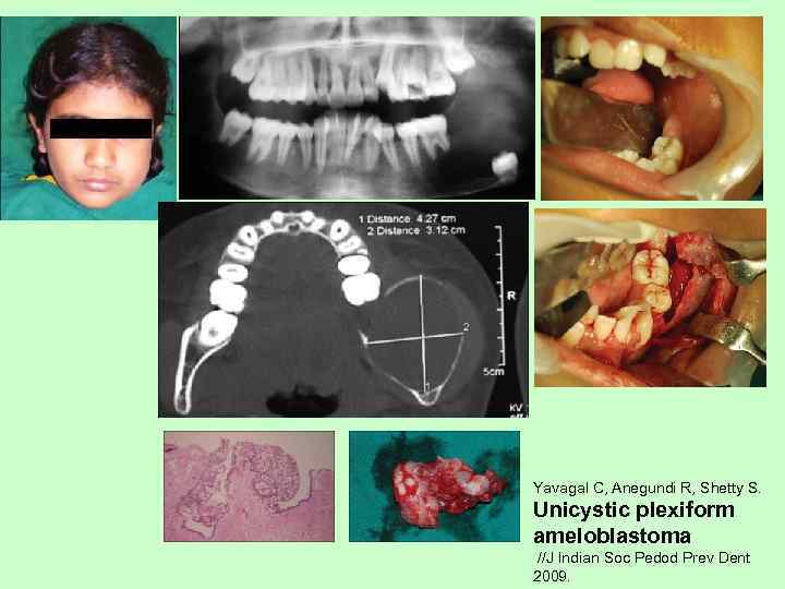 A. Horváth, E. Horváth, S. Popşor Mandibular ameloblastic  carcinoma in a young patient