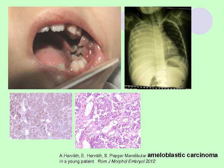 Простая костная киста (юношеская, геморрагическая, травматическая) l Возраст – 10 -14 лет  Клиника