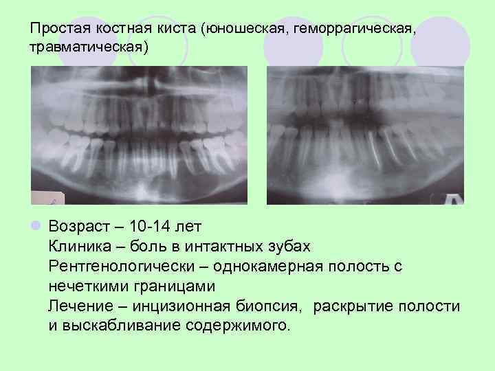 Опухолевидное образование нижней челюсти 