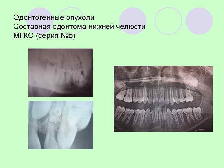Сложная одонтома в области верхней челюсти справа. 