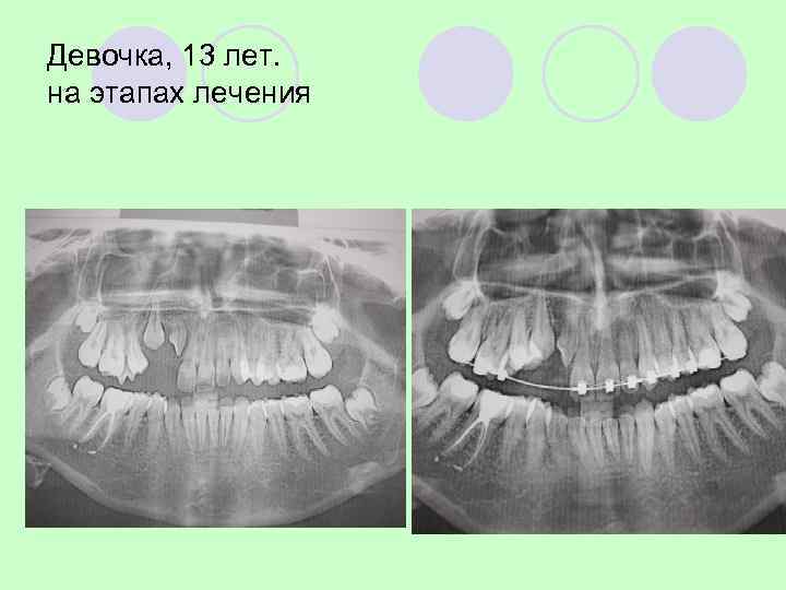 КЛАССИФИКАЦИЯ ОПУХОЛЕЙ КОСТЕЙ 5. Сосудистые опухоли костей   Доброкачественные гемангиома лимфангиома Промежуточные (агрессивные