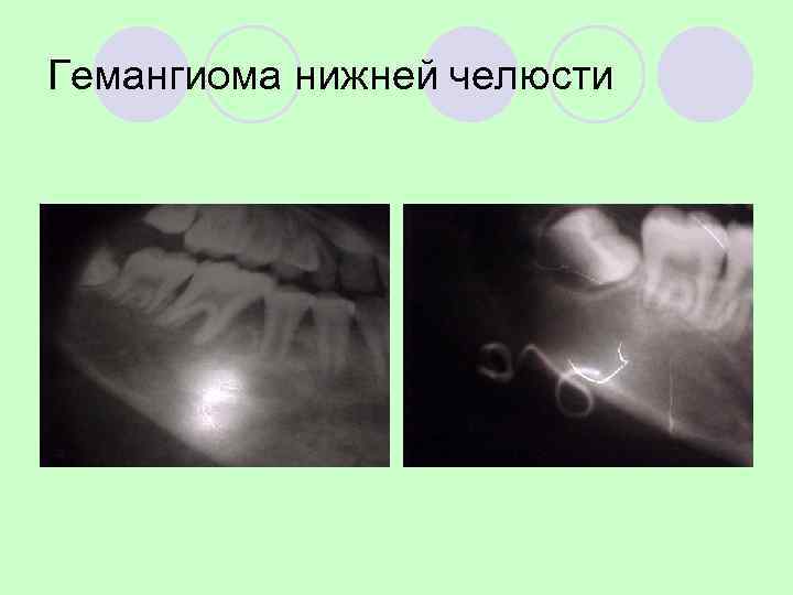 РЭО внутрикостной гемангиомы. 