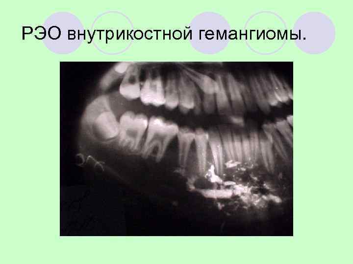 КЛАССИФИКАЦИЯ ОПУХОЛЕЙ КОСТЕЙ 6. Другие соединительнотканные опухоли кости.  Доброкачественные    Злокачественные