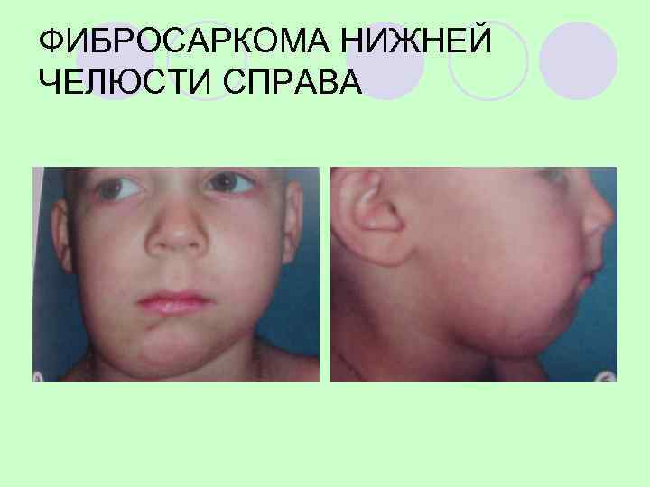 Ортопантомограмма и рентгенограмма макропрепарата нижней челюсти больного 5 -лет с фибросаркомой нижней челюсти 