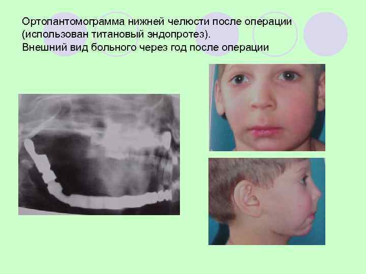КЛАССИФИКАЦИЯ ОПУХОЛЕЙ КОСТЕЙ 7. прочие опухоли костей. Доброкачественные   l Злокачественные  Хордома
